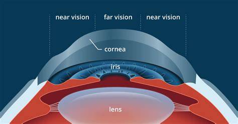 minimum corneal thickness for lasik